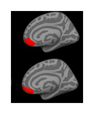 Brain Differences in Bipolar Disorder Type 1 Versus 2