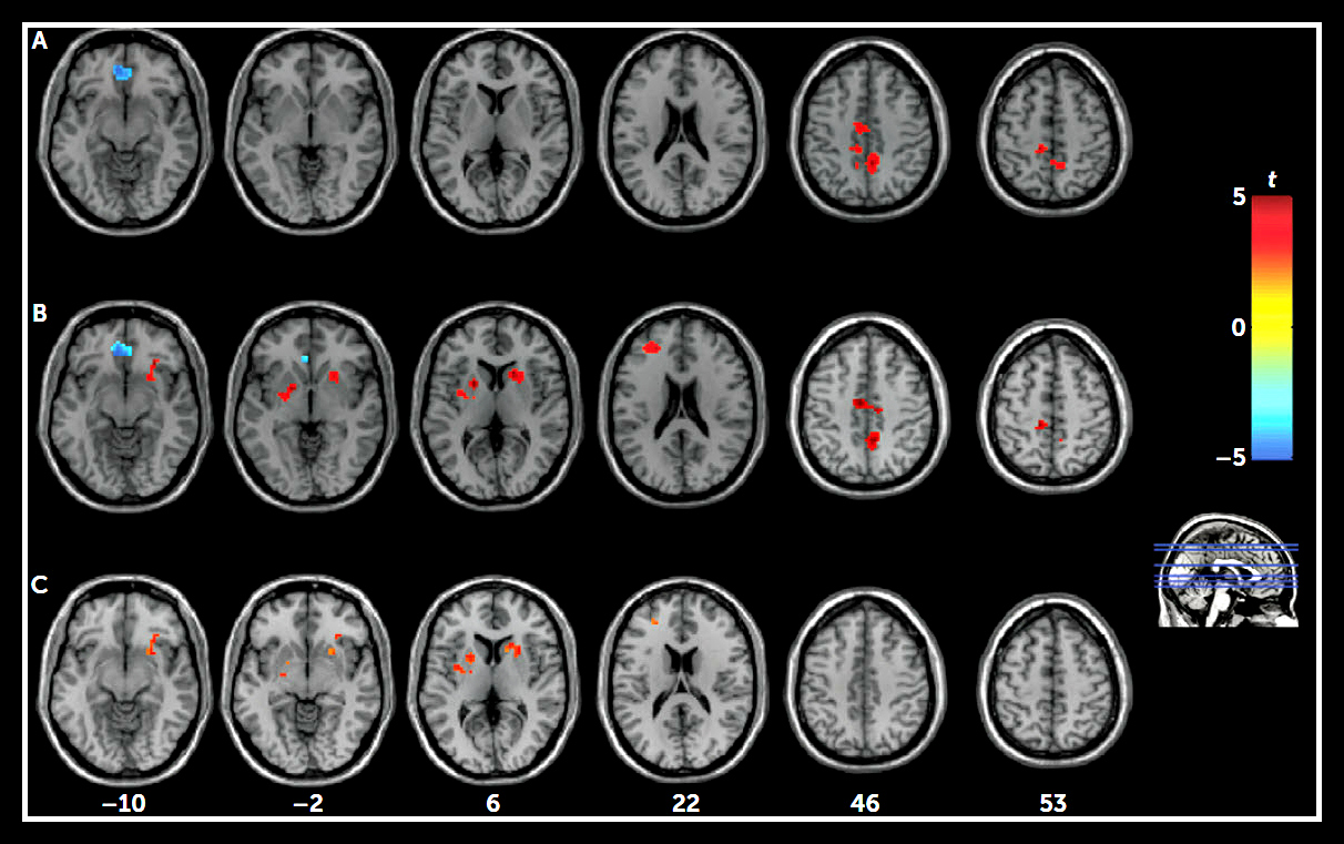 State and Trait Brain Function in Depression